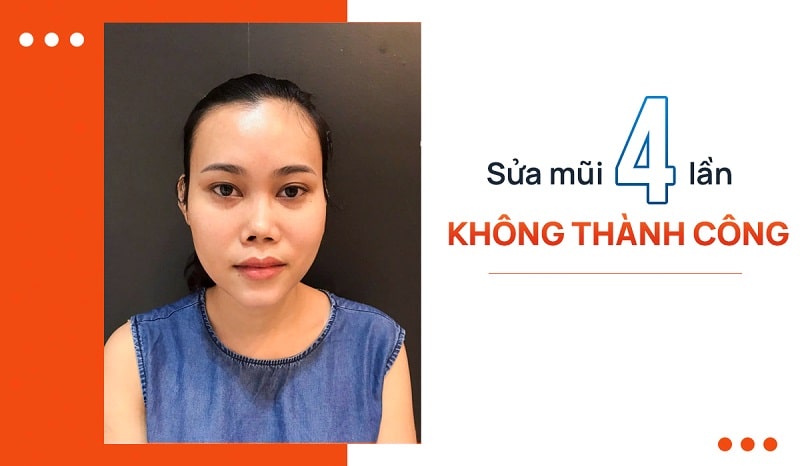 10 nam voi 4 lan sua mui hong
