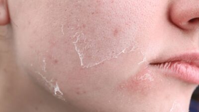 Bí Quyết Dưỡng Da Mùa Đông Luôn Căng Mướt, Không Bong Tróc