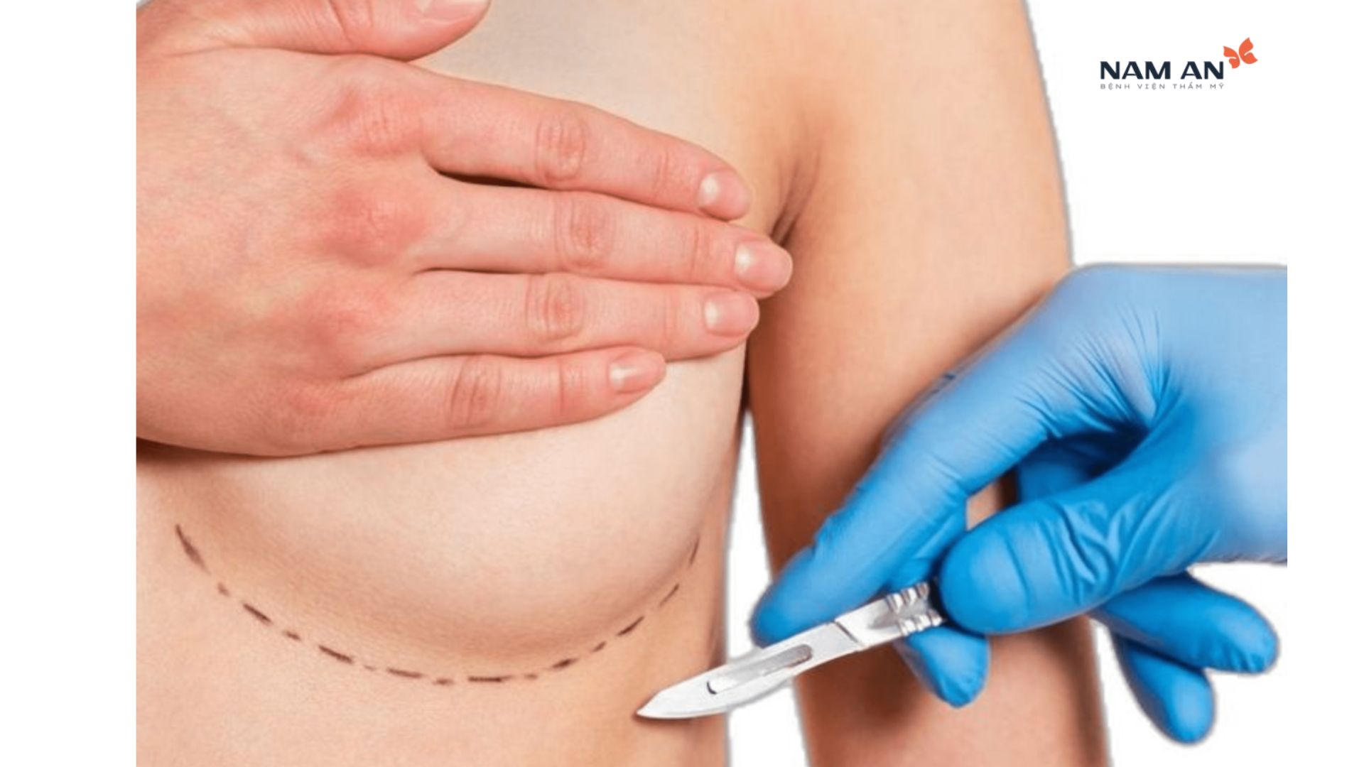 Bí Quyết Nâng Ngực Không Đau Tại Bệnh Vện Thẩm Mỹ Nam An (7)