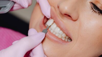 Bọc Răng Sứ Giữ Được Bao Lâu? Bí Quyết Tăng Tuổi Thọ