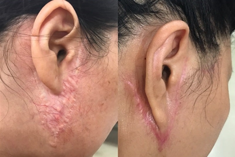 Các Biến Chứng Căng Da Mặt Và Cách Khắc Phục An Toàn