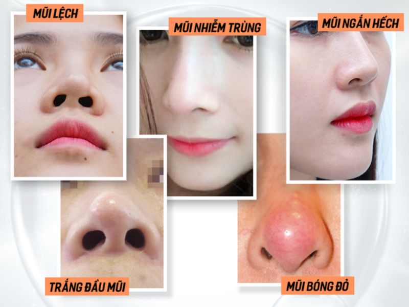 Các Biến Chứng Sau Nâng Mũi Thường Gặp Và Cách Xử Lý