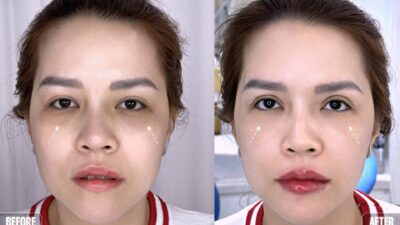 Cách Trị Thâm Quầng, Mắt Trũng Sâu Hiệu Quả Tại Nam An