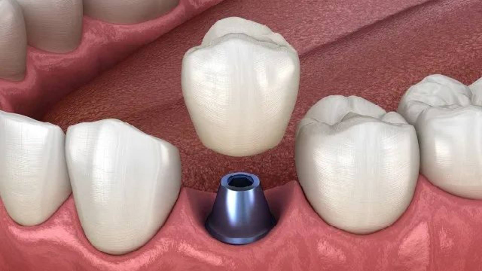 Cấy Ghép Implant Giải Pháp Phục Hồi Răng Mất Hiệu Quả (4)