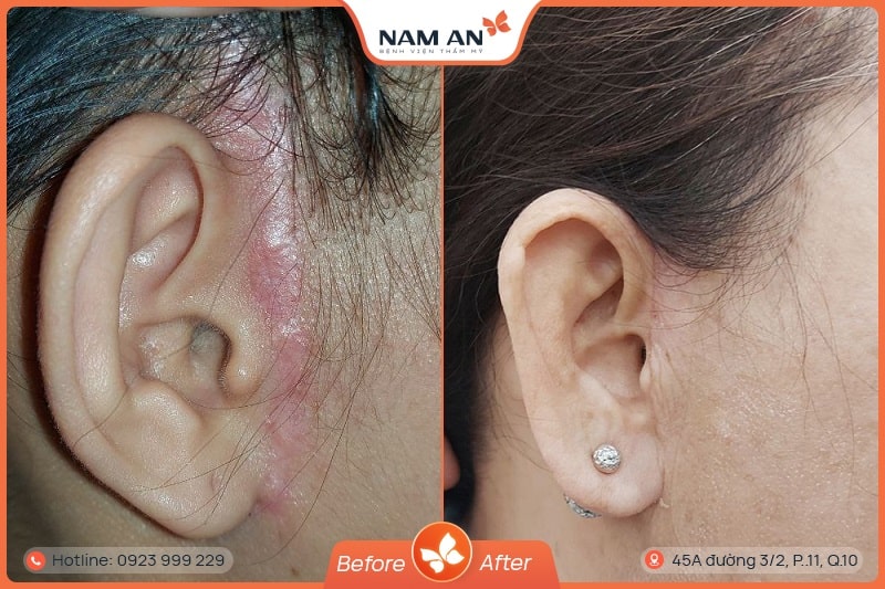 Chỉnh Sửa Căng Da Mặt Bị Hỏng Uy Tín Tại BVTM Nam An (7)