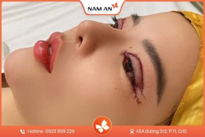 Chỉnh Sửa Mí Mắt Bị Hỏng Uy Tín Tại BV Thẩm Mỹ Nam An
