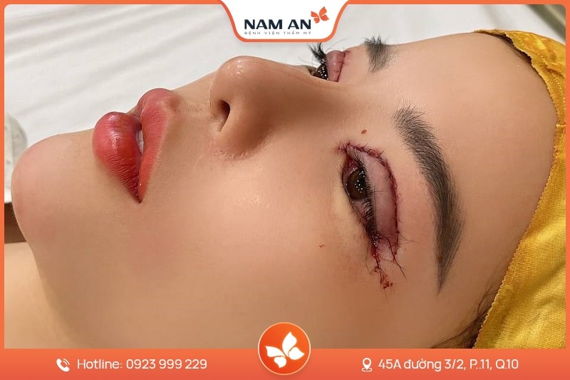 Chỉnh Sửa Mí Mắt Bị Hỏng Uy Tín Tại BV Thẩm Mỹ Nam An (3)