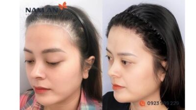 Có Nên Phẫu Thuật Hạ Đường Chân Tóc Không?