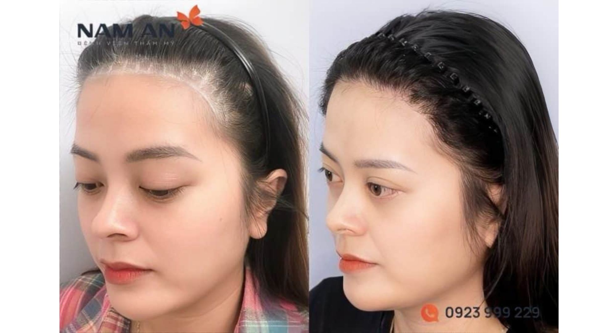 Có Nên Phẫu Thuật Hạ Đường Chân Tóc Không (1)