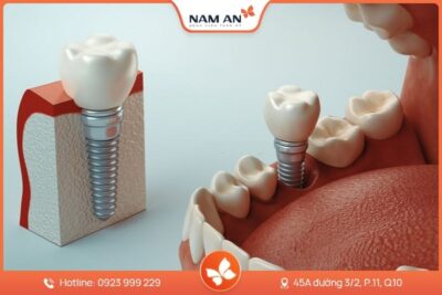 Dịch Vụ Cấy Ghép Trồng Răng Implant Uy Tín Tại Nam An