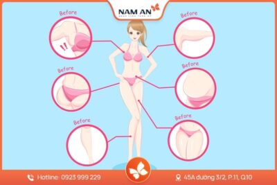 Dịch Vụ Hút Mỡ Toàn Thân An Toàn Tại BVTM Nam An