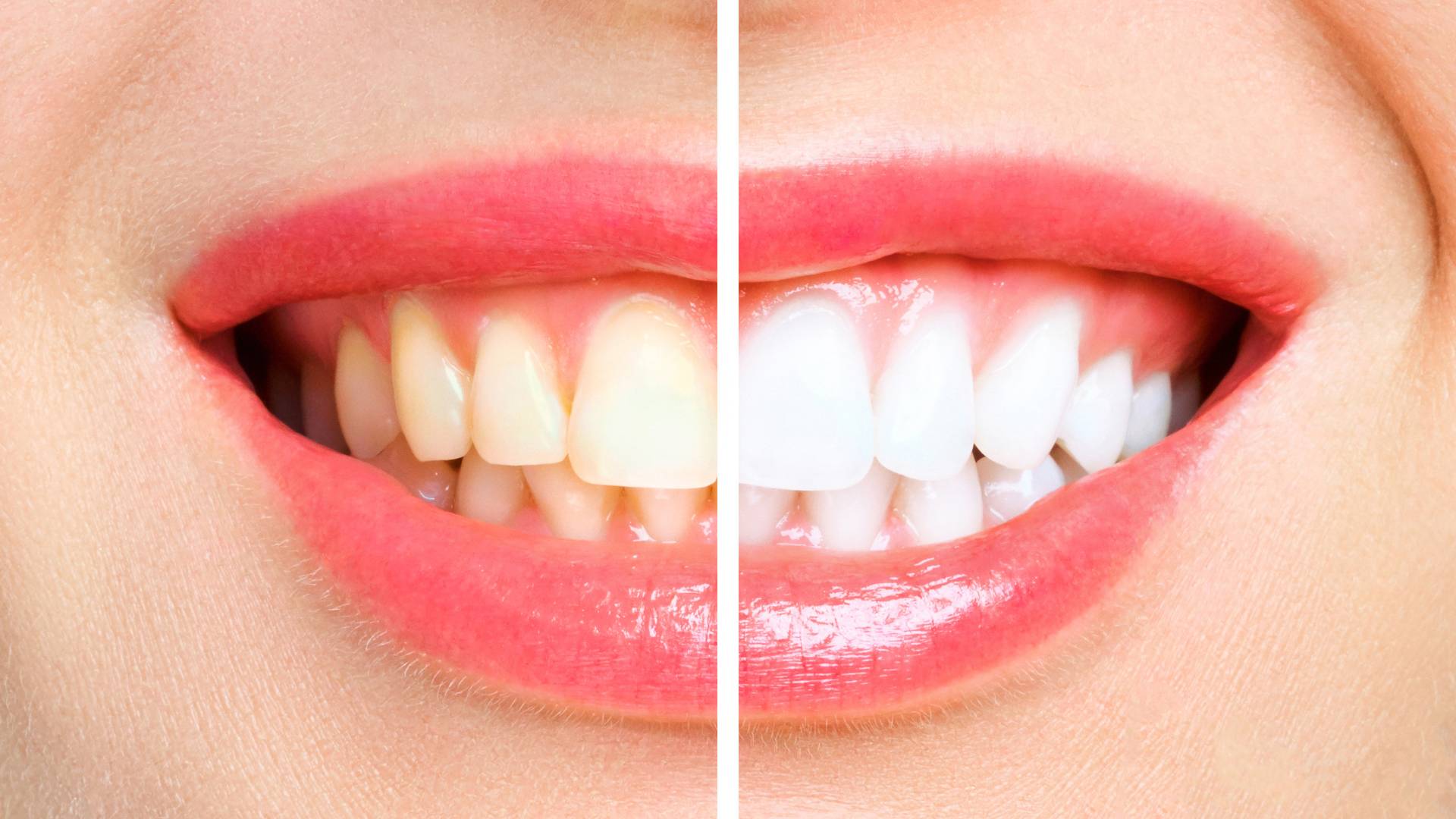 Dịch Vụ Tẩy Trắng Răng Công Nghệ Hiện Đại Tại Nam An
