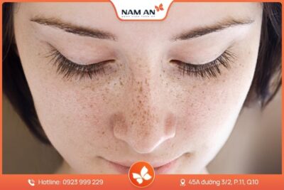Điều Trị Tàn Nhang Dứt Điểm, Da Sáng Mịn Tại Nam An