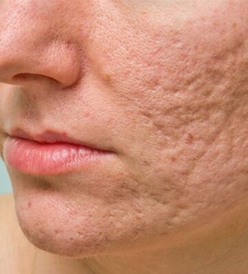 Điều Trị Da Liễu Bệnh Viện Thẩm Mỹ HCM