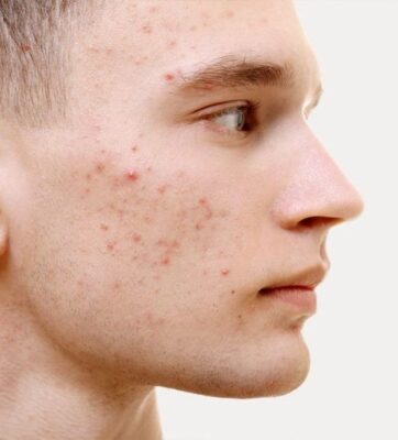 Điều Trị Sẹo Rỗ, Mụn, Quầng Thâm Mắt