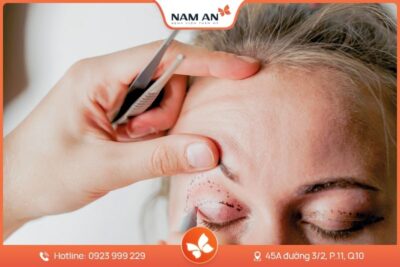 Điều Trị Sụp Mi Mắt Chuẩn Y Khoa Tại BV Thẩm Mỹ Nam An
