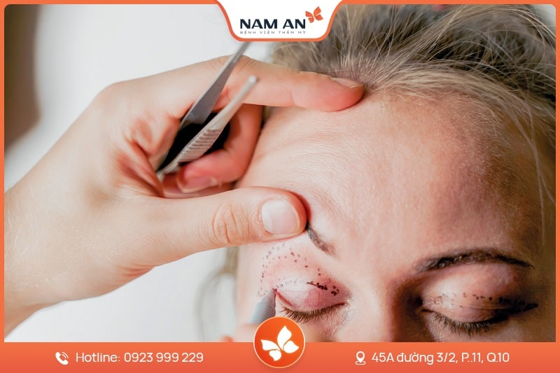 Điều Trị Sụp Mi Mắt Chuẩn Y Khoa Tại BV Thẩm Mỹ Nam An (5)