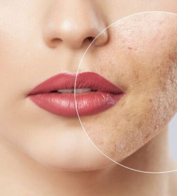 Điều trị mụn, thâm, nám, sẹo rỗ tại bệnh viện thẩm mỹ TP.HCM. Phác đồ chuyên biệt từ bác sĩ da liễu giỏi, công nghệ tiên tiến, an toàn và hiệu quả lâu dài