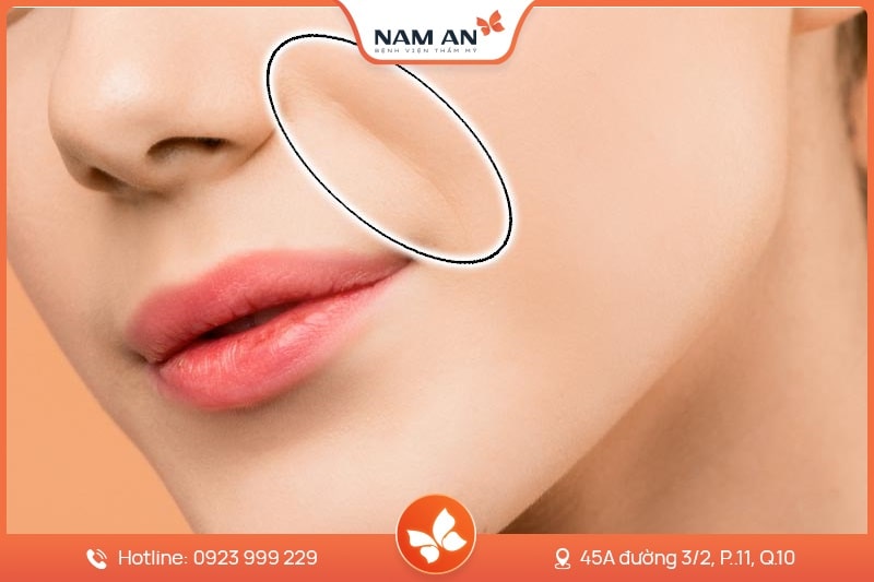 Độn Rãnh Mũi Má - Xóa Nếp Nhăn Trẻ Hóa Tại Nam An (8)