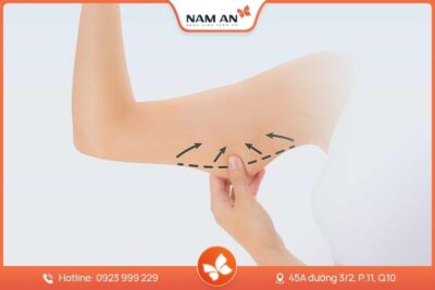 Hút Mỡ Bắp Tay Nhẹ Nhàng, Không Sẹo Tại BVTM Nam An