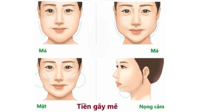 Hút Mỡ Bụng Gây Tê Hay Gây Mê? Giải Đáp Từ Chuyên Gia