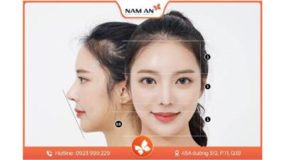 Lưu Ý Quan Trọng Khi Phẫu Thuật Gọt Hàm V-Line