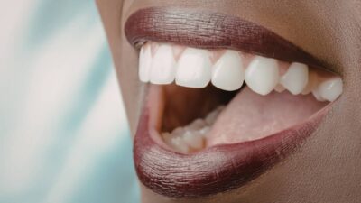 Mặt Dán Sứ Veneer Cao Cấp Siêu Mỏng Tại BVTM Nam An