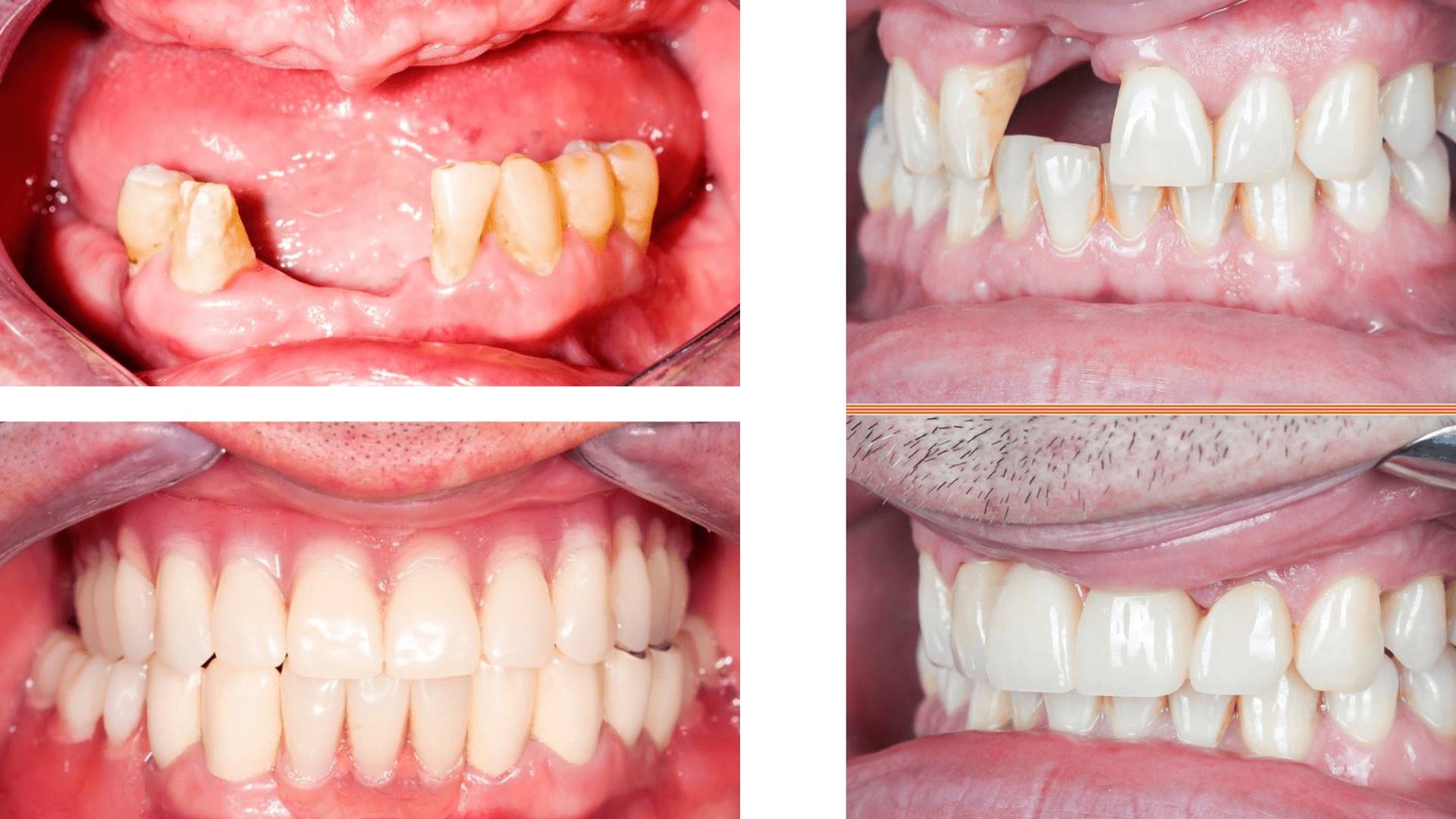 Mất Răng Lâu Năm Cấy Ghép Implant Có Phức Tạp Không (4)