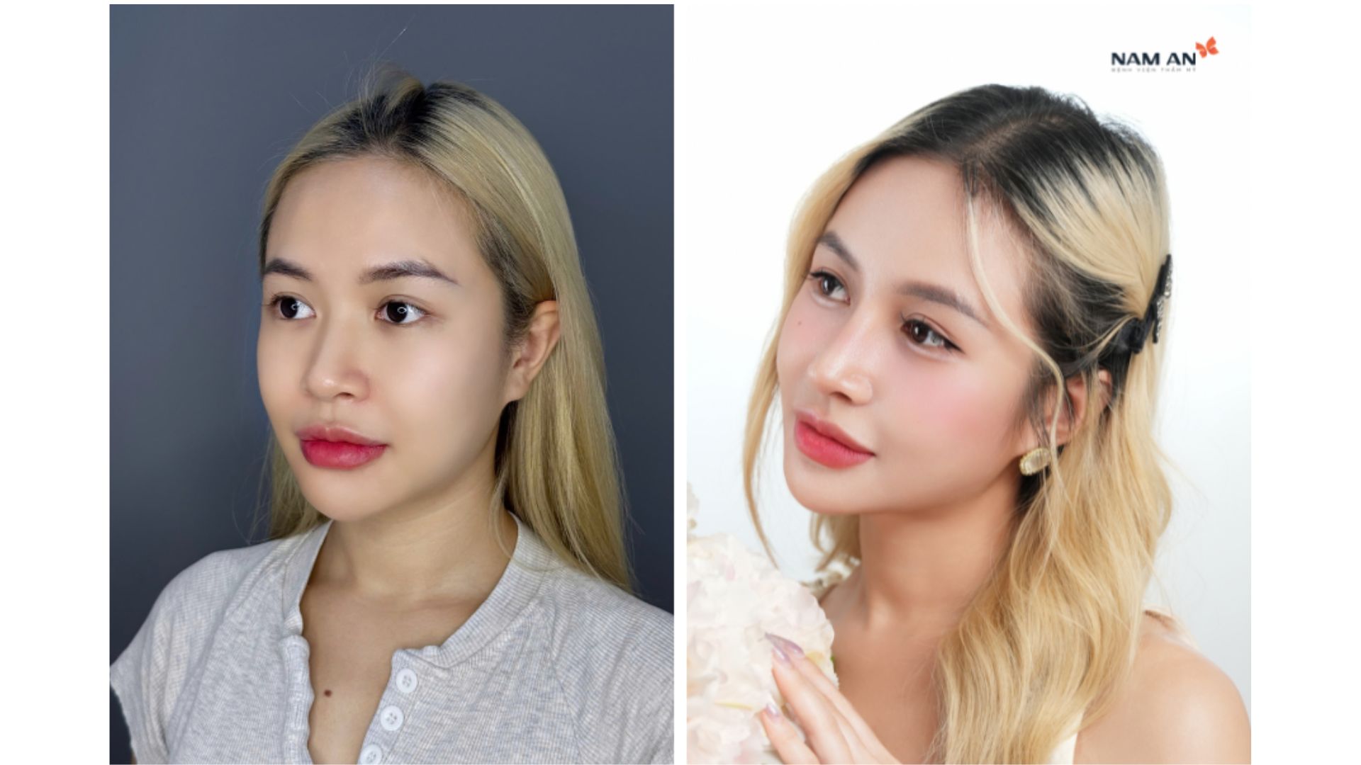 Nâng Mũi Cấu Trúc An Toàn Đón Tết Xinh Lung Linh (6)
