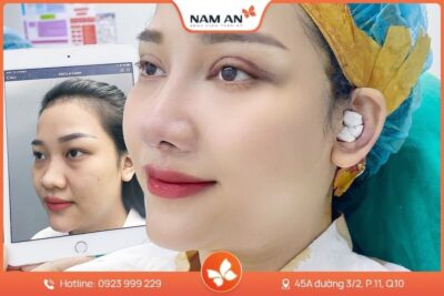 Nâng Mũi S-Line Cấu Trúc Khởi Tạo Đường Cong Mềm Mại