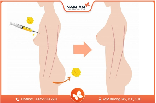 Nâng Ngực Bằng Mỡ Tự Thân Có Bền Không Giữ Được Lâu Không (6)