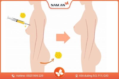 Nâng Ngực Bằng Mỡ Tự Thân Tự Nhiên Chuẩn Y Khoa Tại Nam An