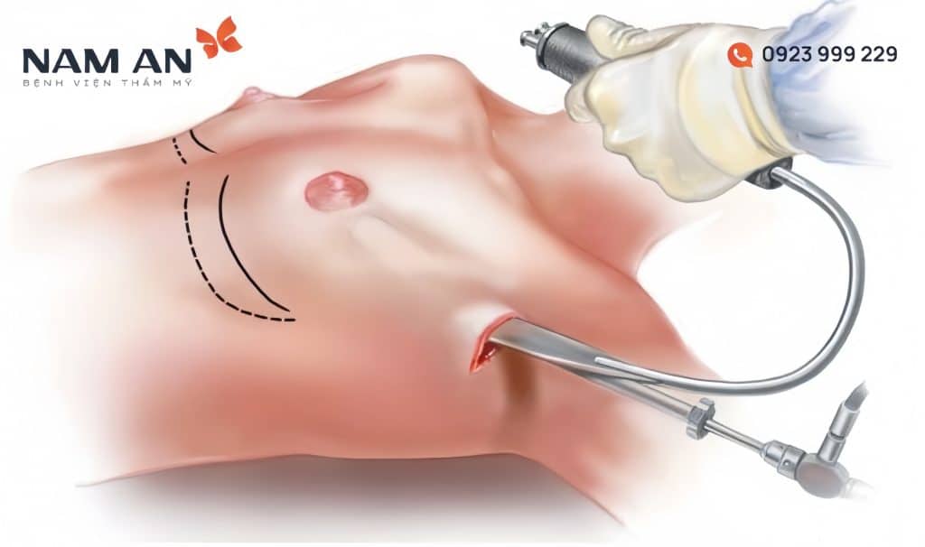 Nâng Ngực Đường Nách Ưu Nhược Điểm Và Lưu Ý Cần Biết (2)