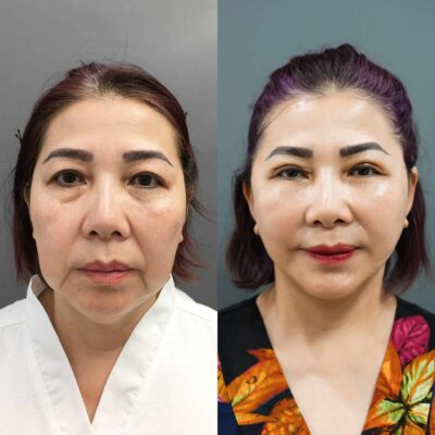 Nên Căng Chỉ Hay Căng Da Mặt Phẫu Thuật? So Sánh Chi Tiết