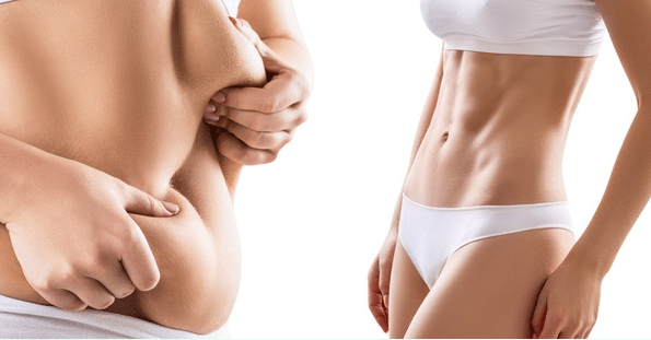 Những Điều Cần Biết Trước Khi Phẫu Thuật Hút Mỡ
