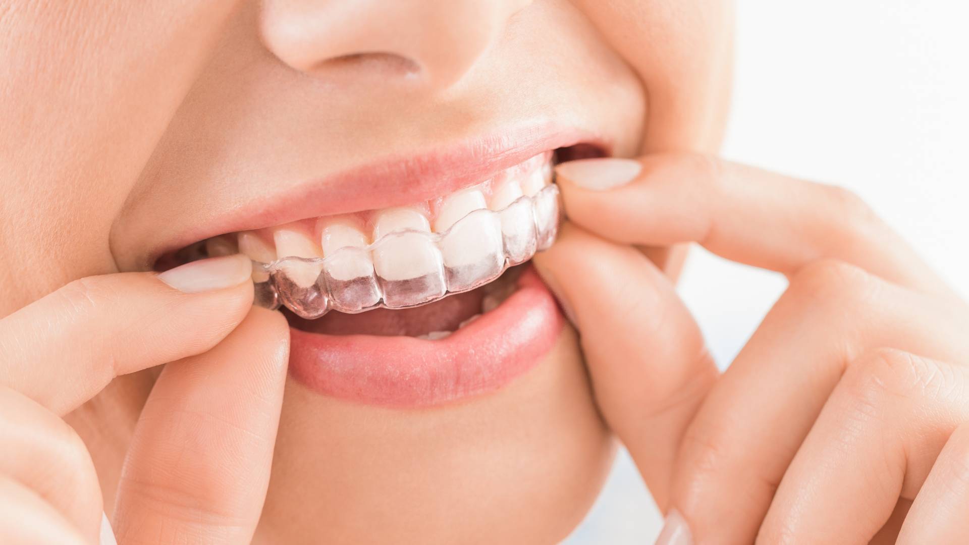 Niềng Răng Khay Trong Suốt Invisalign Khay Đẹp Tại Nam An