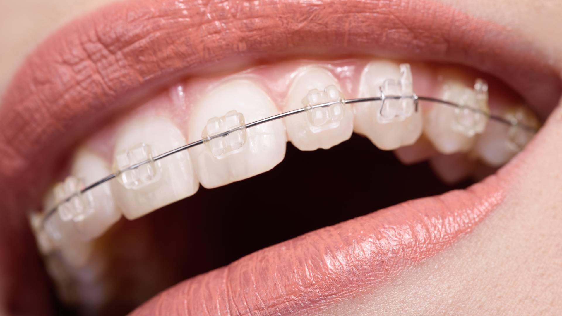 Niềng Răng Mắc Cài Sứ Thẩm Mỹ Cao Chuẩn Khớp Cắn Tại Nam An