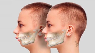 Phẫu Thuật Chỉnh Hàm Hô Khắc Phục Triệt Để Tại Nam An