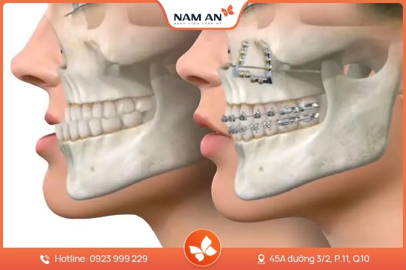 Phẫu Thuật Chỉnh Hàm Móm Do Xương Tại BVTM Nam An (6)