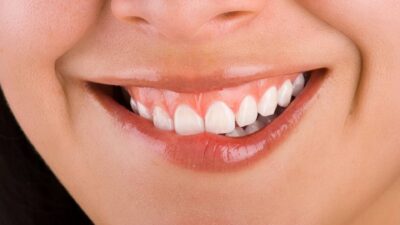 Phẫu Thuật Chữa Cười Hở Lợi Đẹp Tự Nhiên Tại Nam An