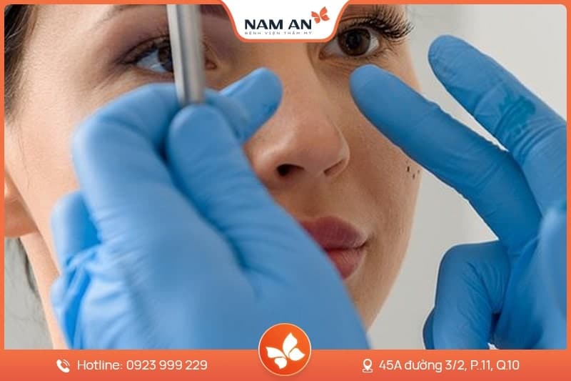 Phẫu Thuật Cuộn Cánh Mũi Thon Gọn Tại BVTM Nam An (10)