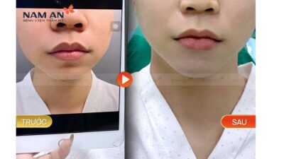 Phẫu Thuật Độn Cằm Duy Trì Được Bao Lâu? Giải Đáp
