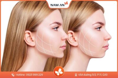 Phẫu Thuật Độn Cằm V-Line Cân Đối Tại BVTM Nam An