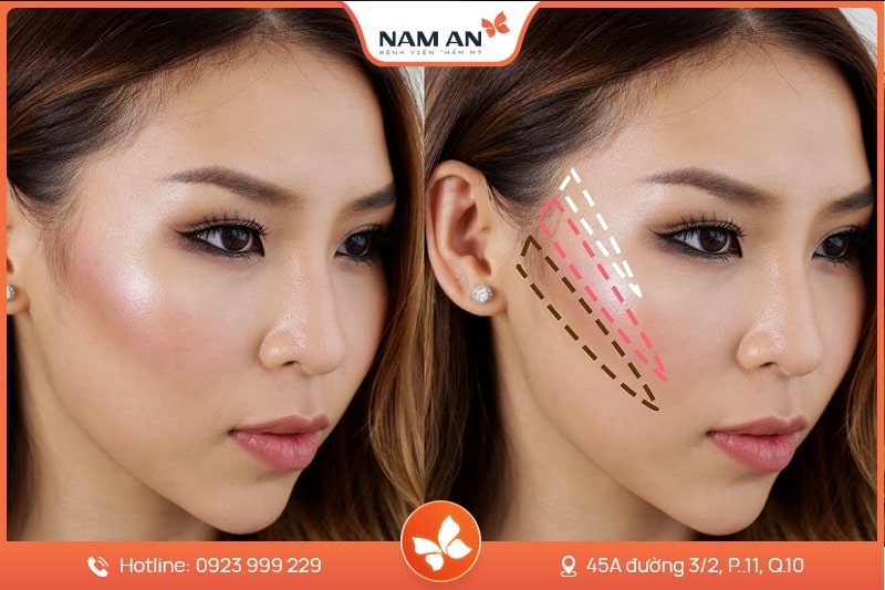 Phẫu Thuật Hạ Gò Má Cao Thanh Tú Tại BVTM Nam An (8)