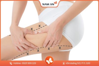 Phẫu Thuật Hút Mỡ Đùi Thon Gọn Tại Thẩm Mỹ Nam An