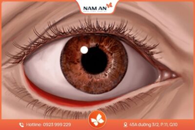 Phẫu Thuật Sửa Lật Mi Mắt An Toàn Tại BVTM Nam An