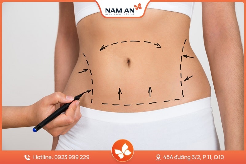 Phẫu Thuật Tạo Hình Thành Bụng Chuẩn Y Khoa Tại Nam An (9)