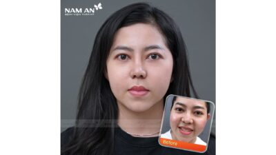 Phẫu Thuật Thu Nhỏ Đầu Mũi Thon Gọn Tại Nam An (2)