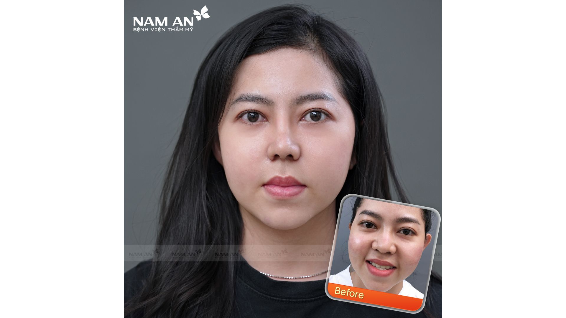 Phẫu Thuật Thu Nhỏ Đầu Mũi Thon Gọn Tại Nam An (2)