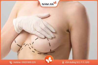 Phẫu Thuật Treo Ngực Sa Trễ – Lấy Lại Vòng 1 Săn Chắc